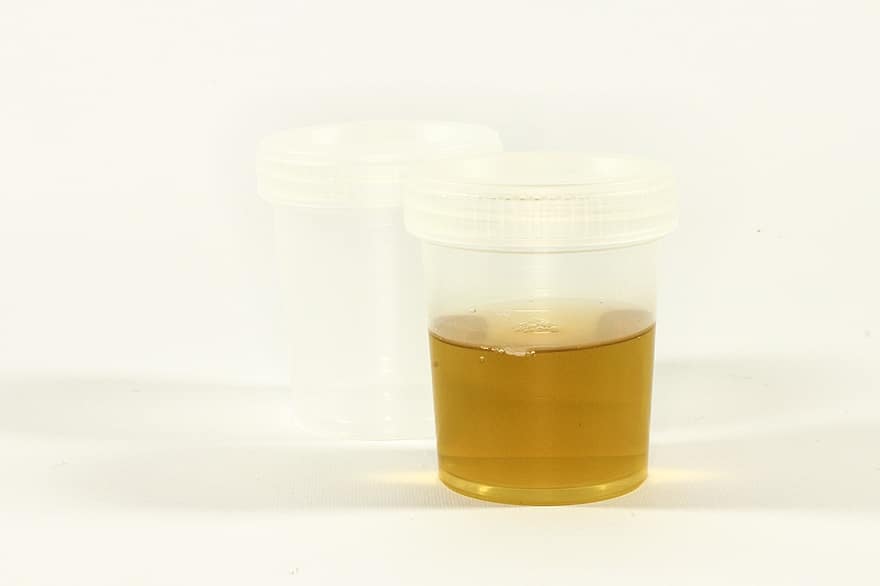 o teste, recipiente de urina, urina, inflamação, análise, médico, laboratório, tubo, diagnósticos, pesquisa, o médico