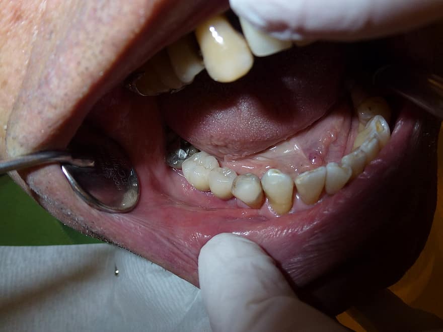 implantieren, Zahnheilkunde, Zahnarzt, Zähne