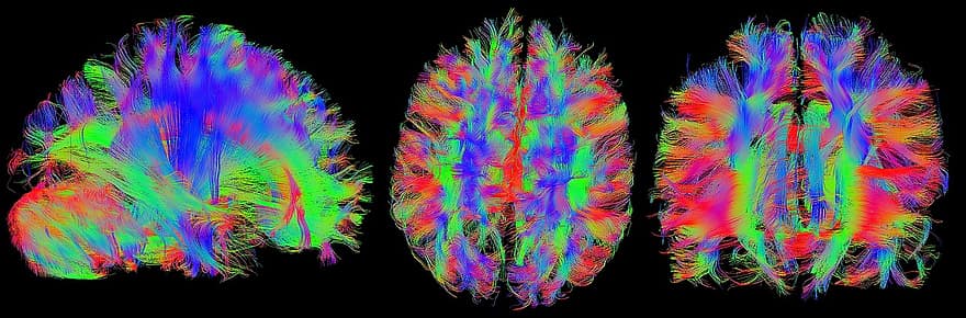 hjärna, mrt, magnetisk resonansbildning, huvud, Traktografi, nerver, Nervfibrer, anslutningar, skalle, Dti, tensor