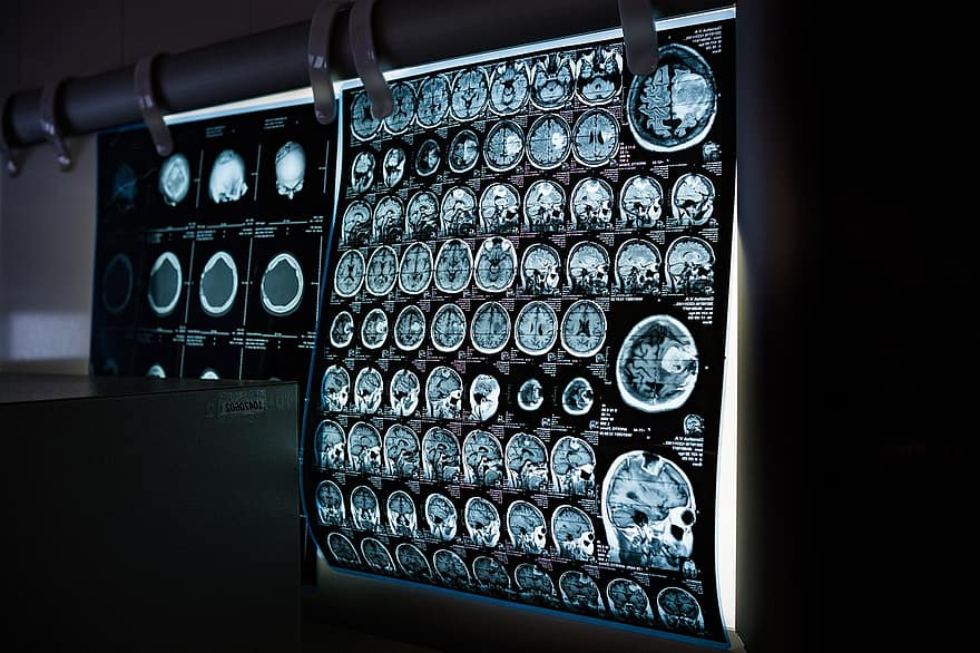 radiografia, mri, escàner CT, tomografia assistida per ordinador, imatges per ressonància magnètica, medicina, neurologia