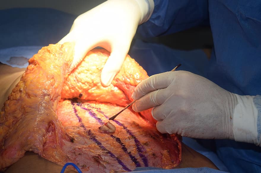 plastyka brzucha, Dermolipektomia, operacja plastyczna, medyczny, sala operacyjna