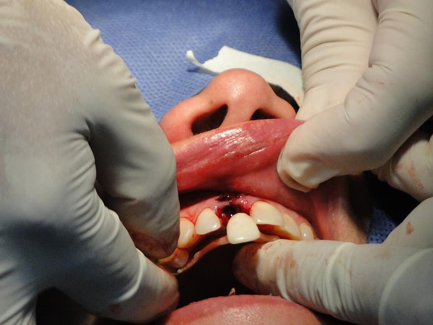 cirurgia, dents, operació, estomatologia