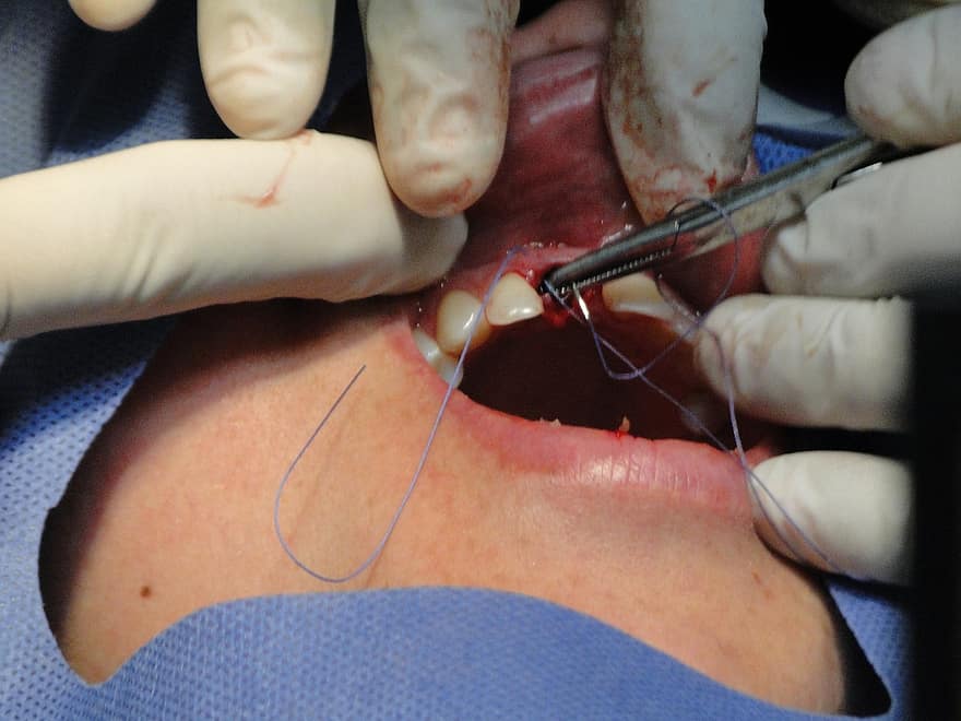 χειρουργική επέμβαση, δόντια, λειτουργία, οδοντιατρική