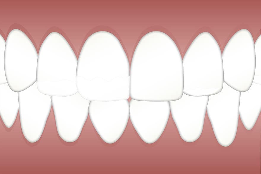 dentale, fluorosi, screziato, denti, Salute, dentista, odontoiatria, dente, igiene, orale, pulito