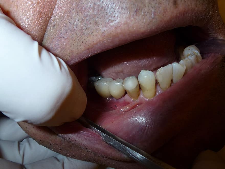 implantát, zubní lékařství, zubař, zuby