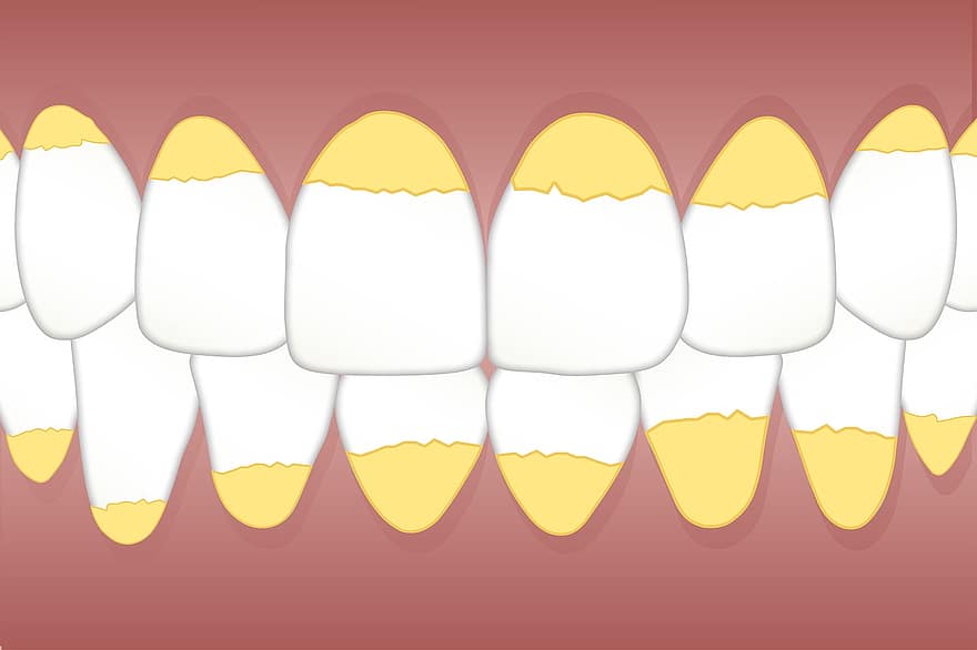 dental, cálculo, dentes, tártaro, branco, local, língua, remendos, dentista, higiene, odontologia