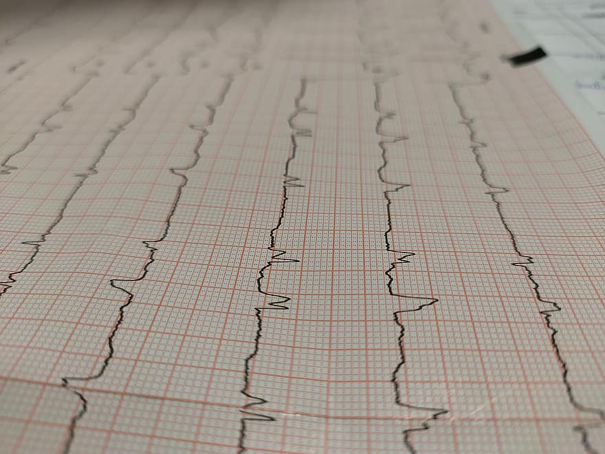 elektrocardiogram, hartaanval, tracing, cardiologie