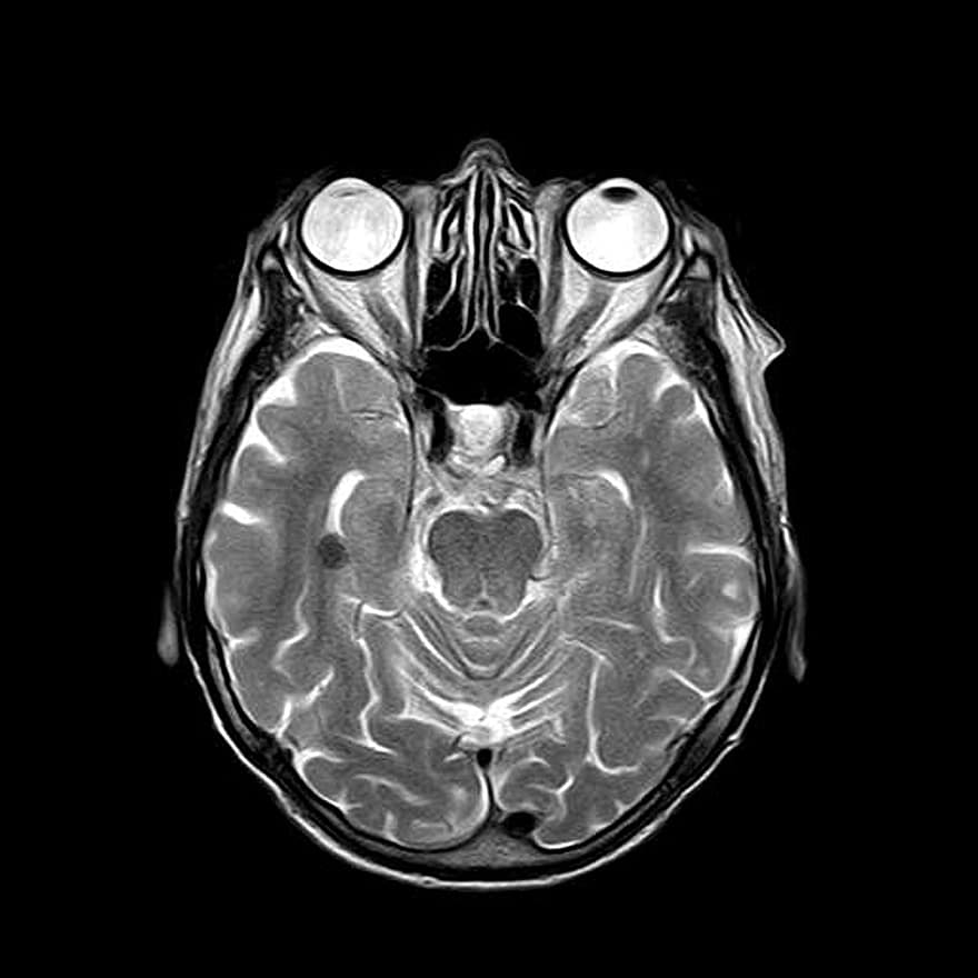 mri, magnetico, raggi X, cranio, capo, cervello, medico, radiologia, indagine, dai un'occhiata, umano