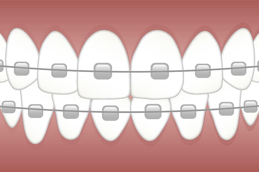 tirantes, dientes, dentista, odontología, ortodoncia, diente, salud, cable, dental, ortodoncista, sano