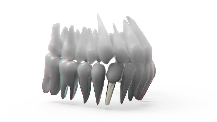 Zähne, Kiefer, 3D-Modell, Kieferorthopädie