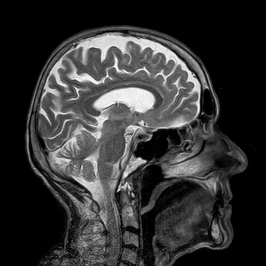 mri, magnetinis, x spindulys, kaukolė, galva, smegenys, medicinos, radiologija, tyrimą, patikrinti, žmogus