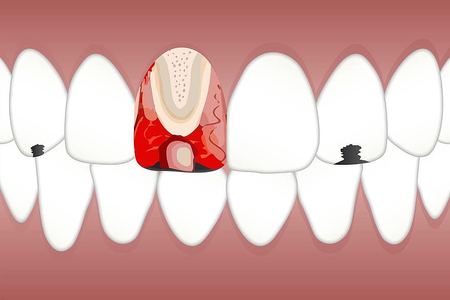 tann, Pulpitis, hvit, sted, tunge, lapper, tannlege, hygiene, tenner, tannbehandling, munn