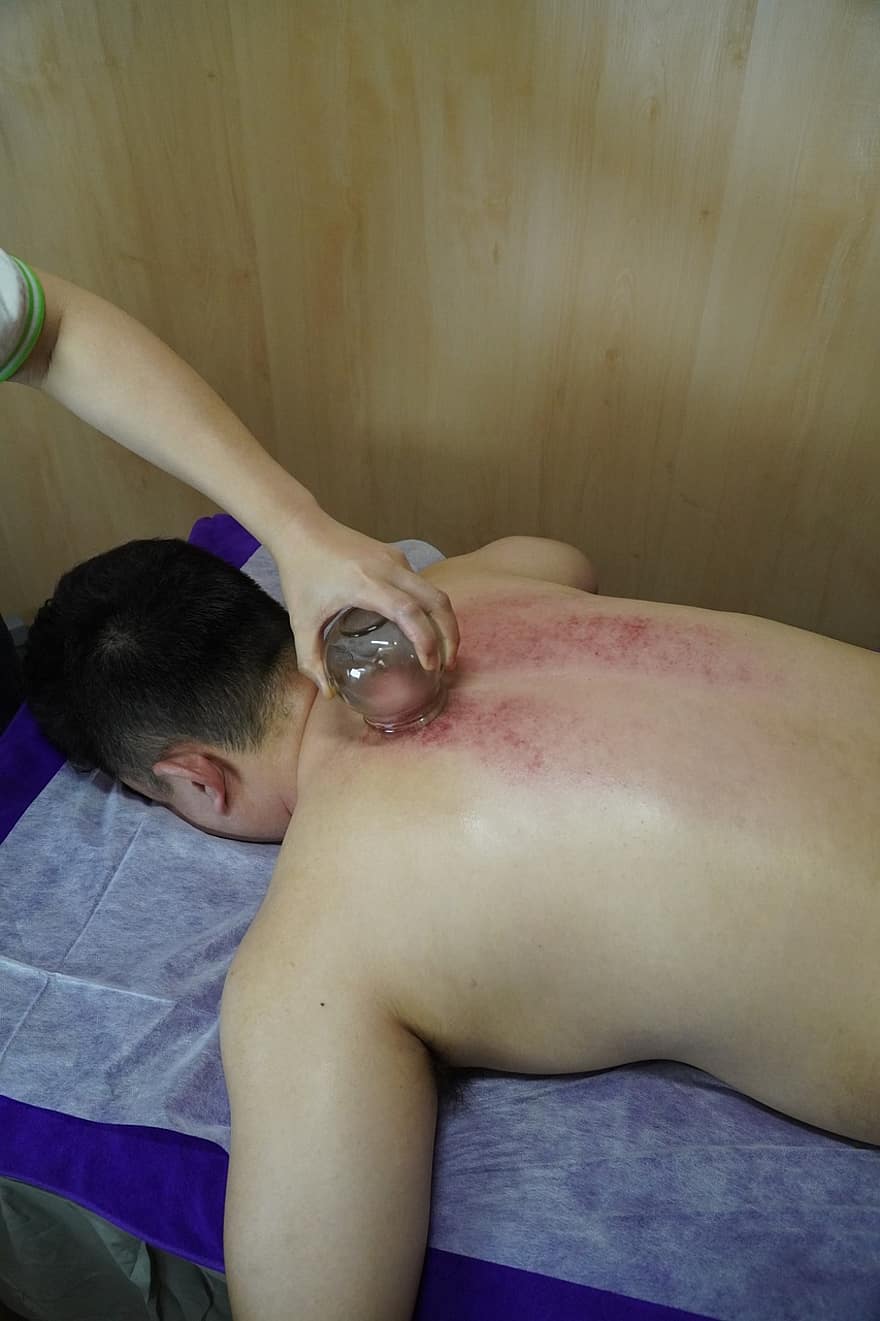 Cupping, Chinese Medicine, Healthy, Relaxation