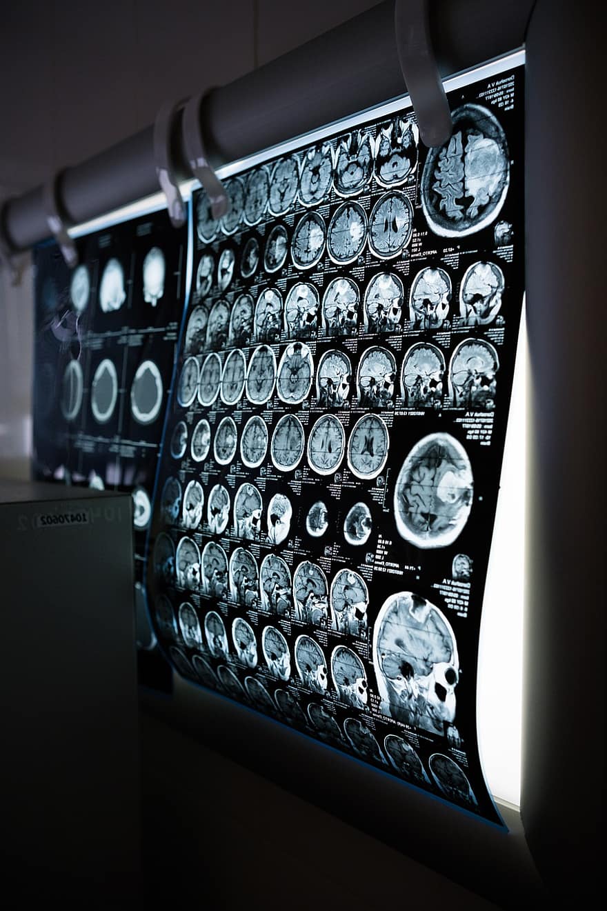 CT-scan, mri, hoofd, hersenen, magnetische resonantie beeldvorming, ziekenhuis, medische ingreep, Medische resultaten, Medisch lezen, geneeskunde, gezondheidszorg en medicijnen