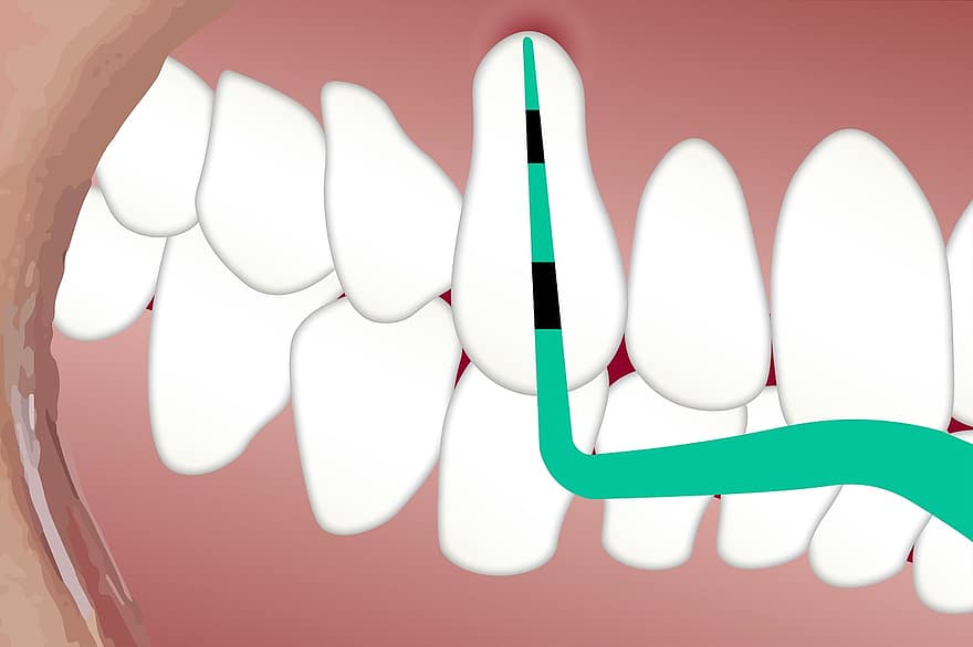 dental, ficka, djup, tänder, ohälsosam, vit, fläck, tunga, plåster, tandläkare, hygien