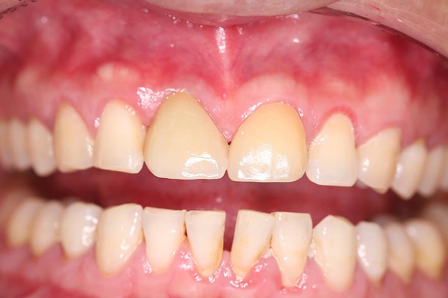 Denti impiantati, impiallacciatura, Restauro dentale, denti, bocca, odontoiatria, Igiene orale, igiene
